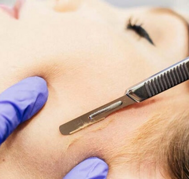 aesthetics clinic in saltaire dermablading